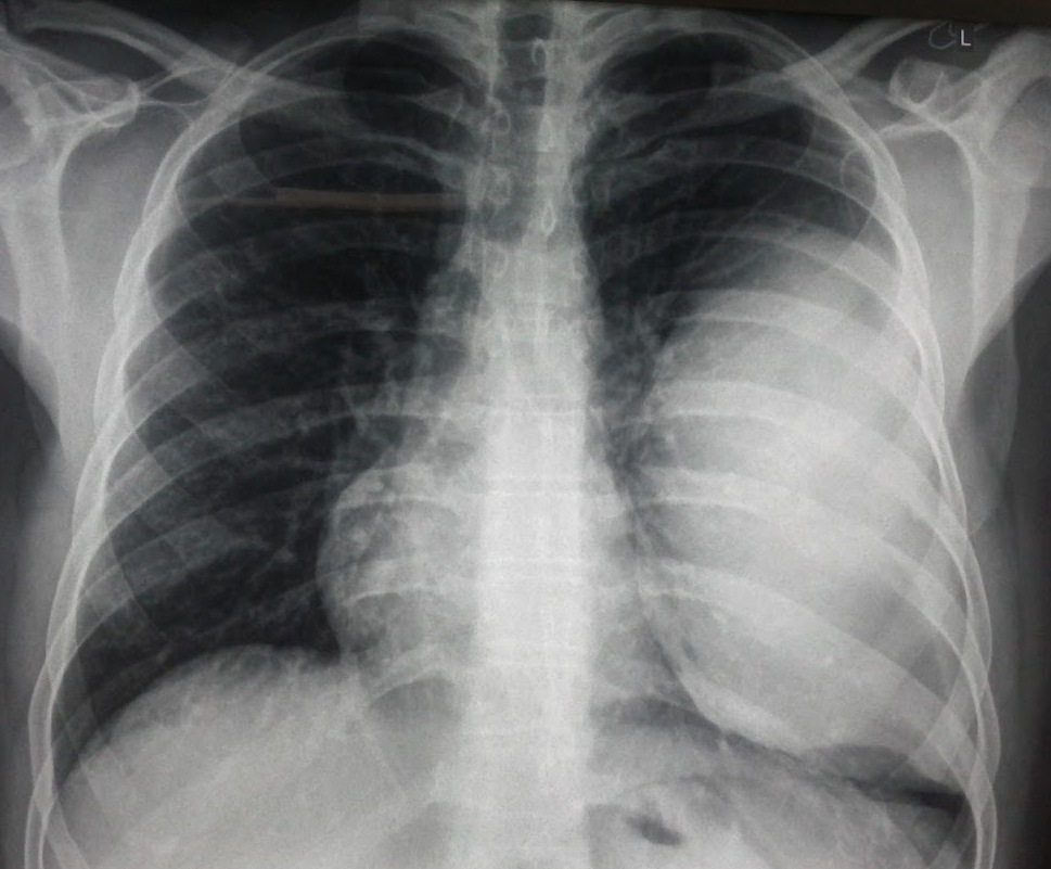 Figure 1. Chest x-ray depicting a large lesion occupying the left hemithorax.