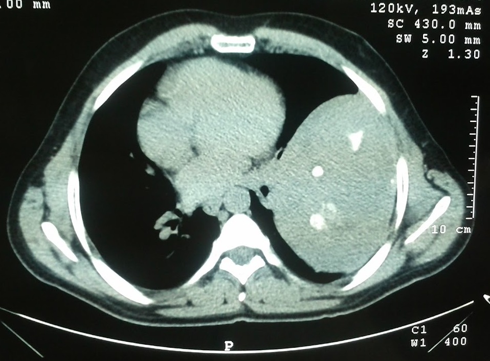 Figure 2. Chest Computed Tomography revealing a giant intrathoracic mass in the left pleural cavity. Compression of the left lung and heart is clearly indicated.