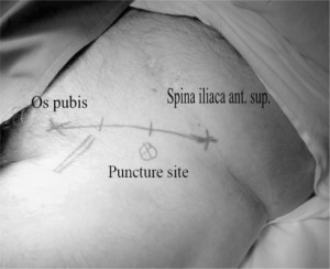 Figure 1. The anatomical landmarks of Fascia Iliaca Block. The line connects the anterior superior iliac spine (ASIS) and the pubic sym-physis. On this line the tertiles are marked. The needle point entry is 1-2 cm caudally on the junction between the middle and lateral tertile (‘x’ sign on the picture).The site of the femoral artery has also been marked.
