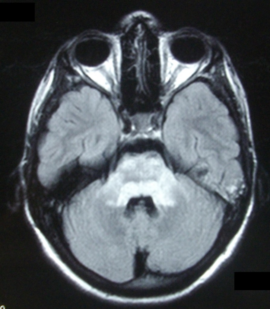 Figure 1: The patient's brain MRI scan during ICU stay, showing a “bright” area in the pons on T2-wighted sequence, indicative of CPM.