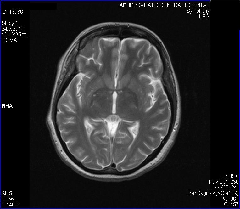 Cerebral Magnetic Resonance Imaging (MRI): Slightly increased MR signal in T2-FLAIR images in the hippocampus, without abnormal enrichment after i.v. administration of contrast agent. These finding were suggestive of limbic encephaliltis.